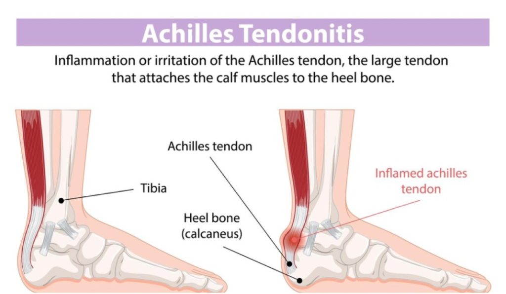 Bagaimana memperkuat tendon untuk kesehatan dan kinerja fisik