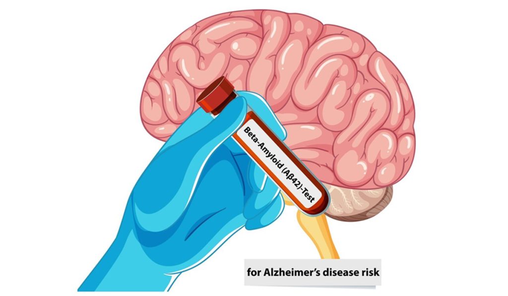 Penelitian baru tentang eliminasi plak amiloid beta dapat menunda Alzheimer