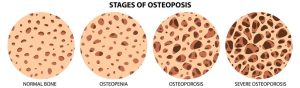 Tiga langkah jika tubuh alami osteoporosis, lakukan skrining lebih awal